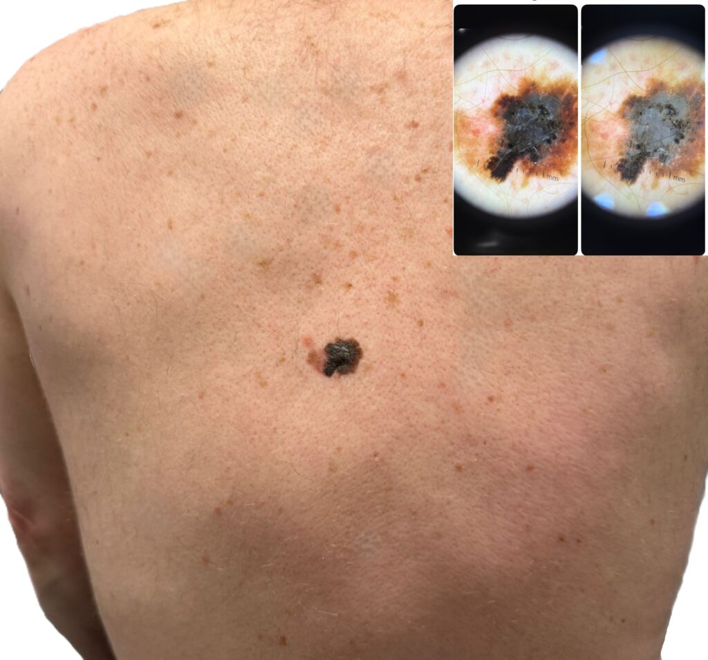 Combined image showing a melanoma on a participant’s back and the corresponding dermatoscope view, captured during a Mobile Screening workplace skin check.