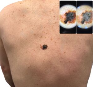 Combined image showing a melanoma on a participant’s back and the corresponding dermatoscope view, captured during a Mobile Screening workplace skin check.