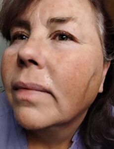 Alt text: Employee face showing subtle skin change near mouth that appeared normal but was later diagnosed as basal cell carcinoma