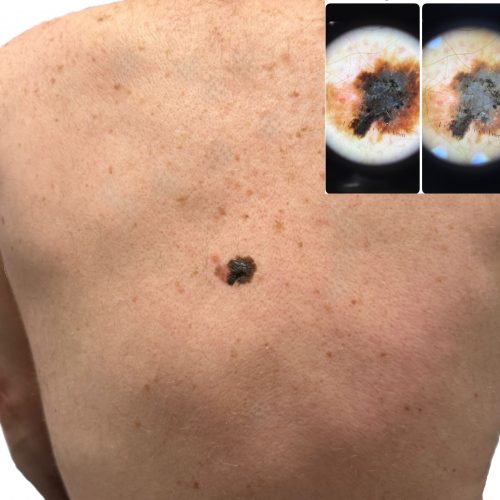 Combined image showing a melanoma on a participant’s back and the corresponding dermatoscope view, captured during a Mobile Screening workplace skin check.