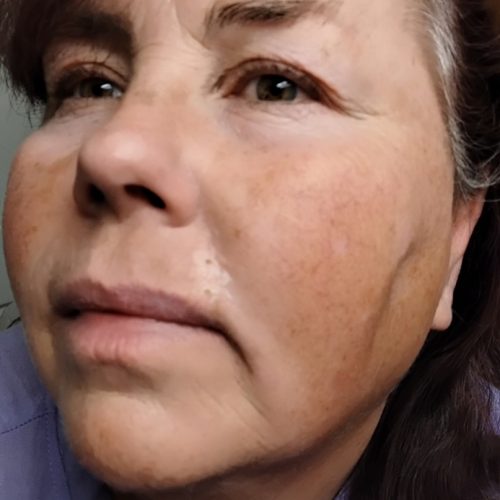 Alt text: Employee face showing subtle skin change near mouth that appeared normal but was later diagnosed as basal cell carcinoma